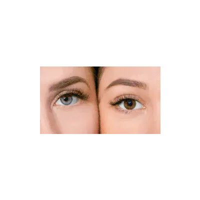 Non Surgical Facelift Results in New York City