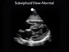 Cardiac Echocardiography - Subxiphoid View - SonoSite, Inc.