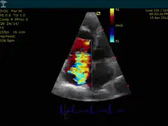 Echocardiogram Cor Pulmonale, PHTN, Pulmonary Hypertension.